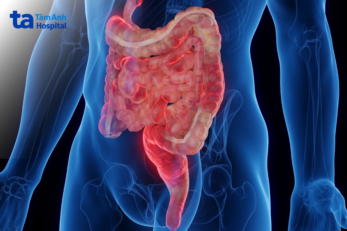 lupus mao mạc treo tiêu hóa