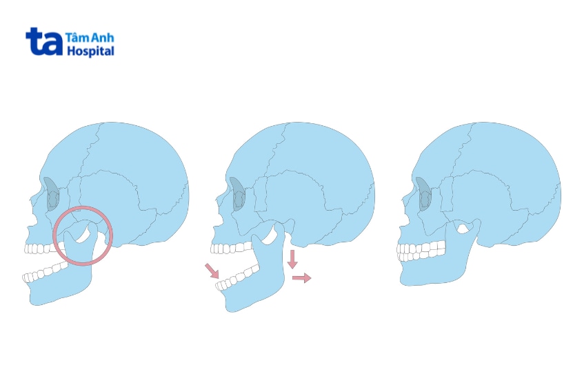 Hình minh họa ba giai đoạn lồi cầu trượt khỏi khớp thái dương hàm