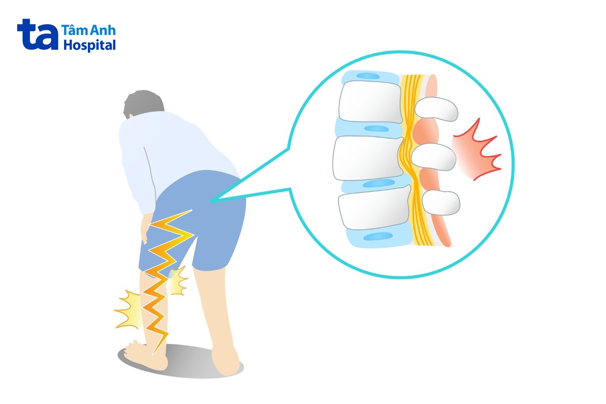 mổ hẹp ống sống thắt lưng