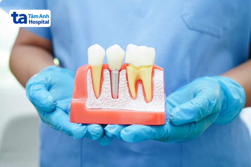 Bác sĩ cầm mô hình trụ implant cắm trong xương hàm bên cạnh răng thật