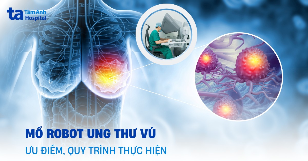 Mổ robot ung thư vú là gì? Chỉ định, ưu điểm và quy trình phẫu thuật
