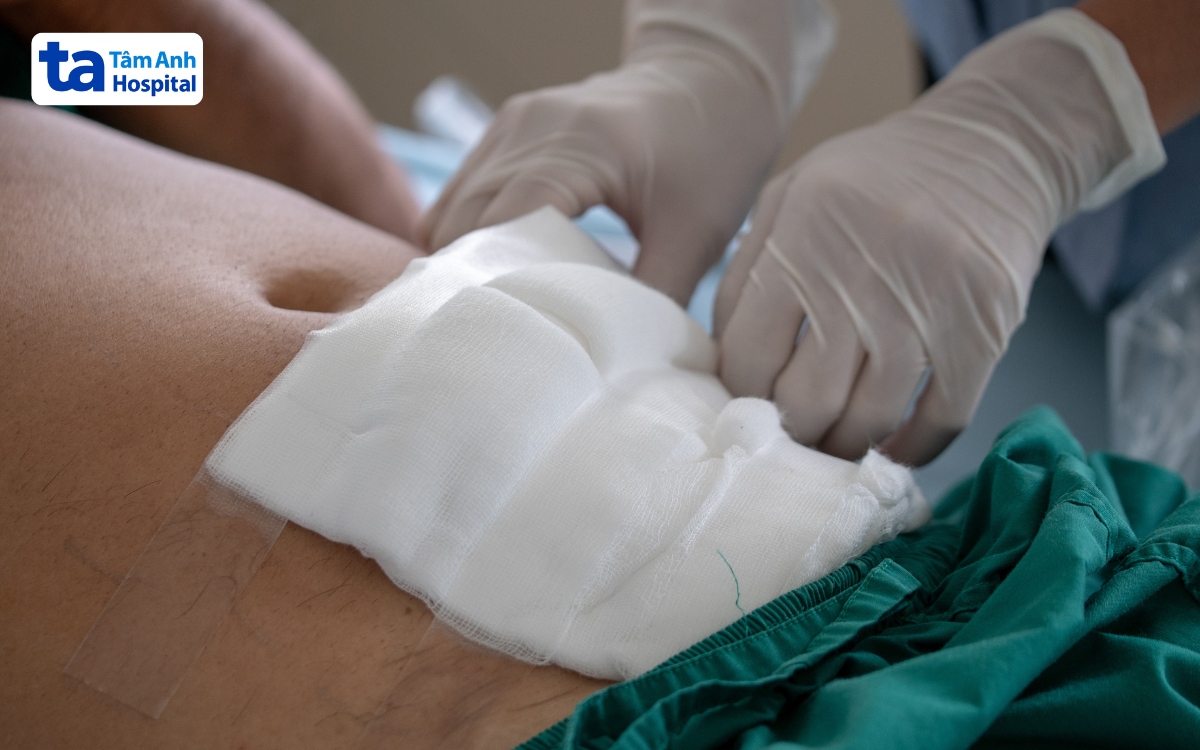 mổ ruột thừa bao lâu thì tập thể dục được