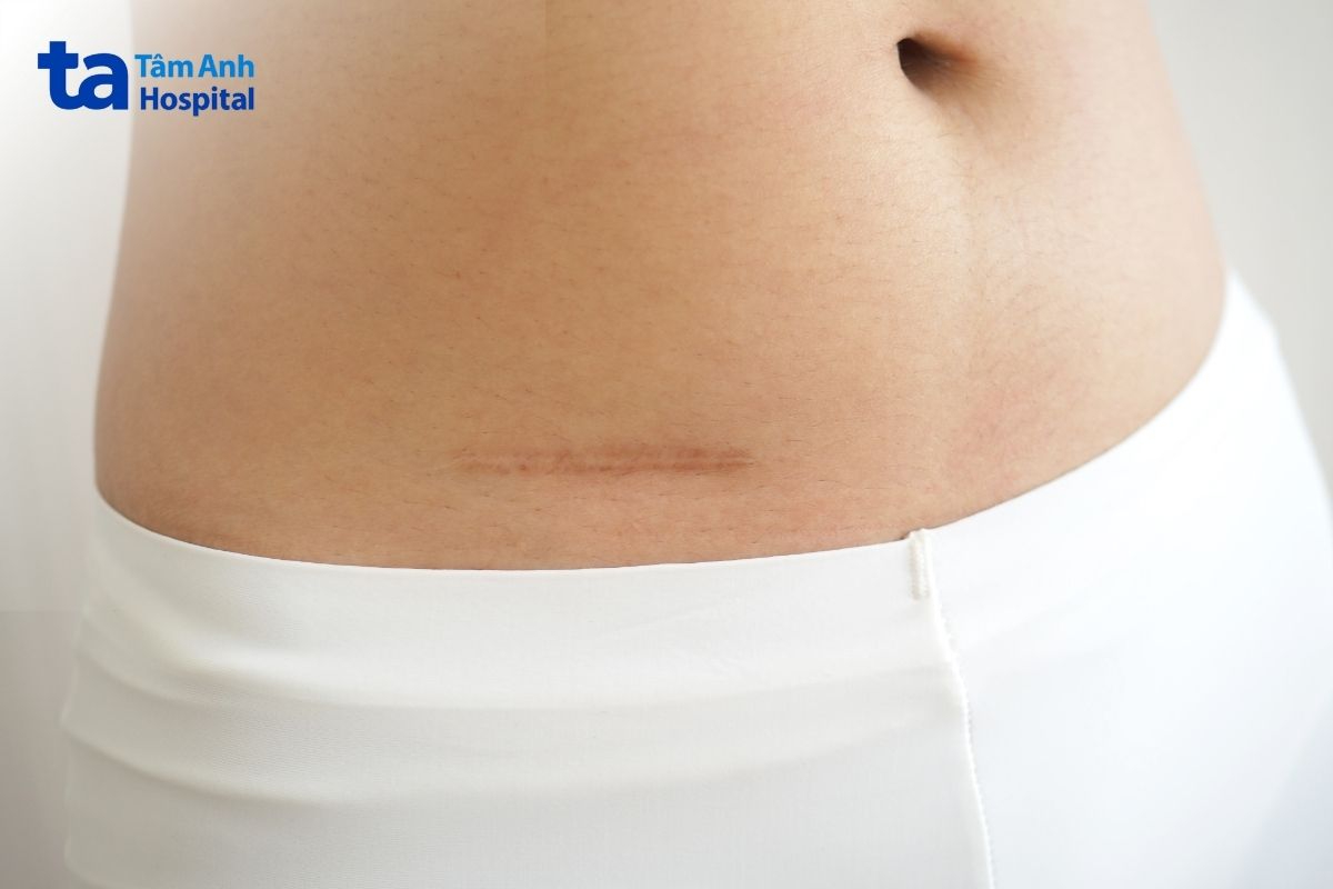 Mổ Ruột Thừa Để Lại Sẹo