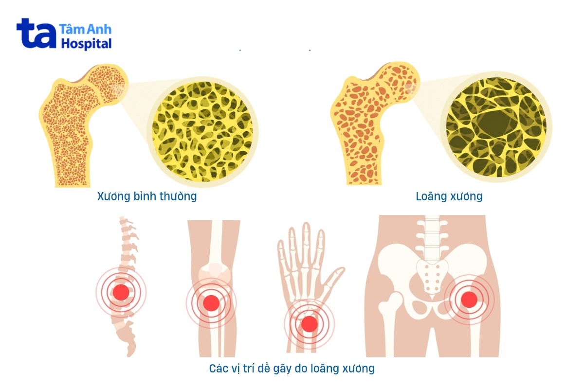 ngày loãng xương thế giới