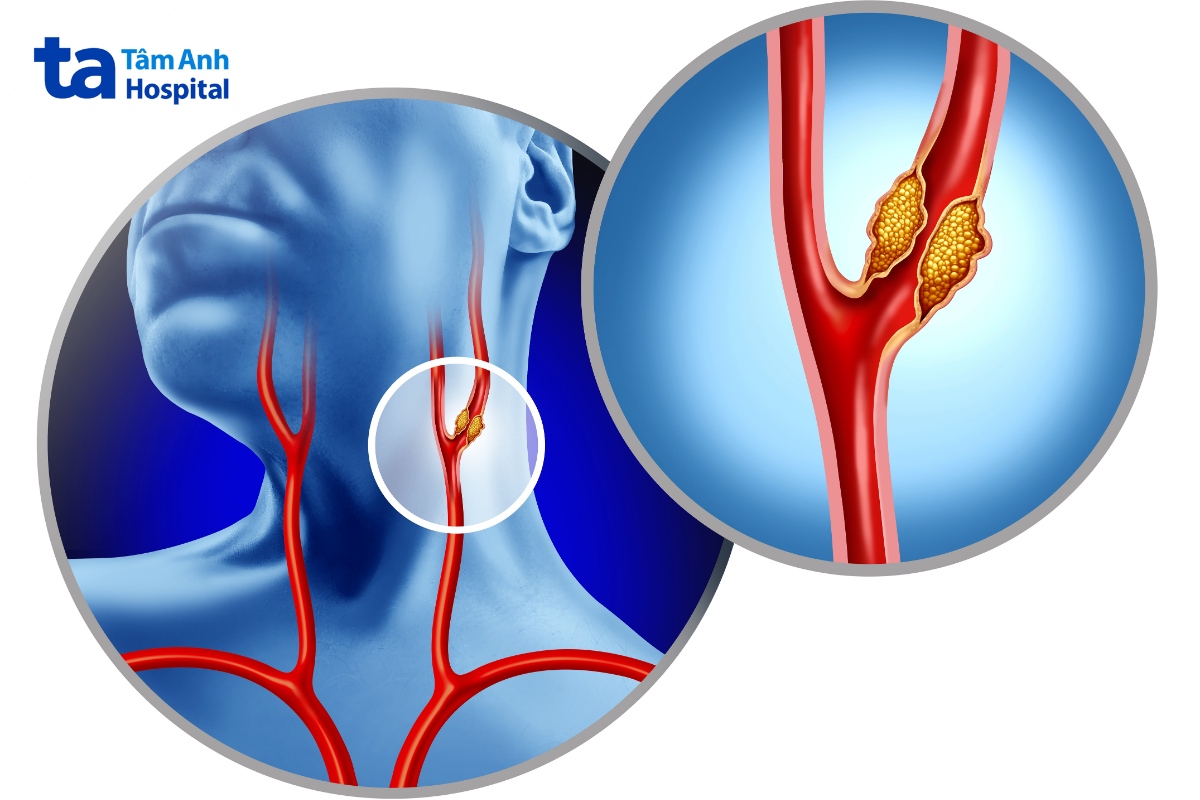 Nguyên Nhân Gây Ra Tiếng Thổi Động Mạch Cảnh