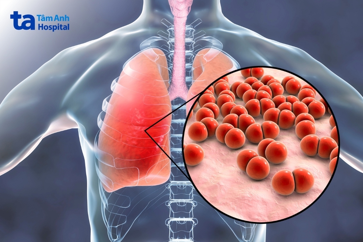 nhiễm trùng hoặc viêm đường hô hấp như viêm phổi, viêm phế quản