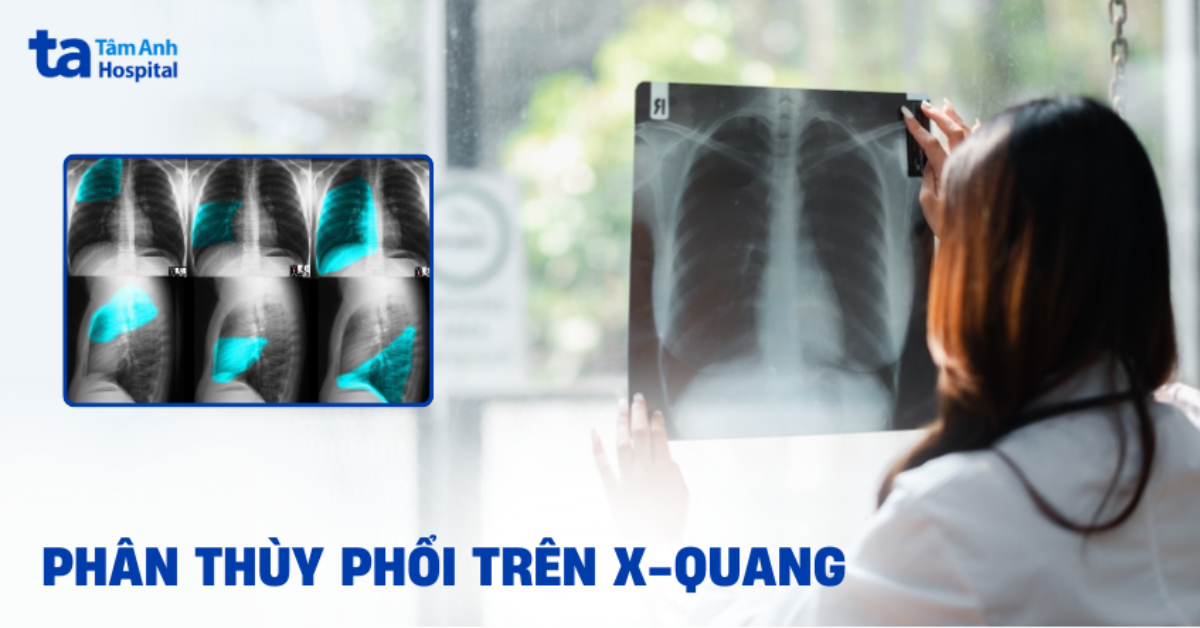 Phân thùy phổi trên phim X-quang: Cách nhận diện