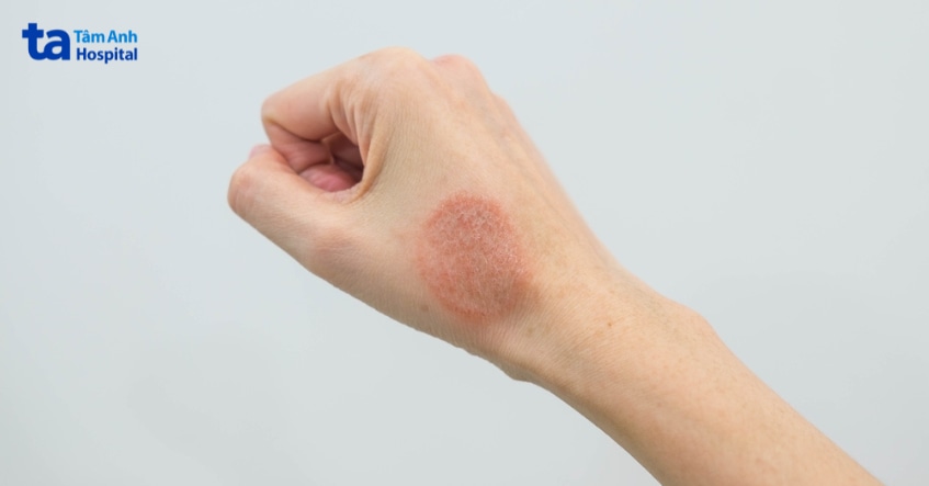 Phát ban da có thể xảy ra khi sử dụng Voriconazole.