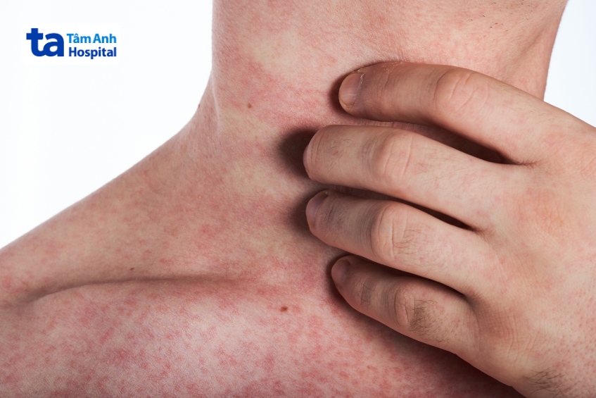 phát ban sốt xuất huyết gây ngứa và nổi ban đỏ