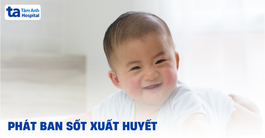 Phát ban sốt xuất huyết bị nổi ngứa phải làm sao? Bao lâu khỏi?