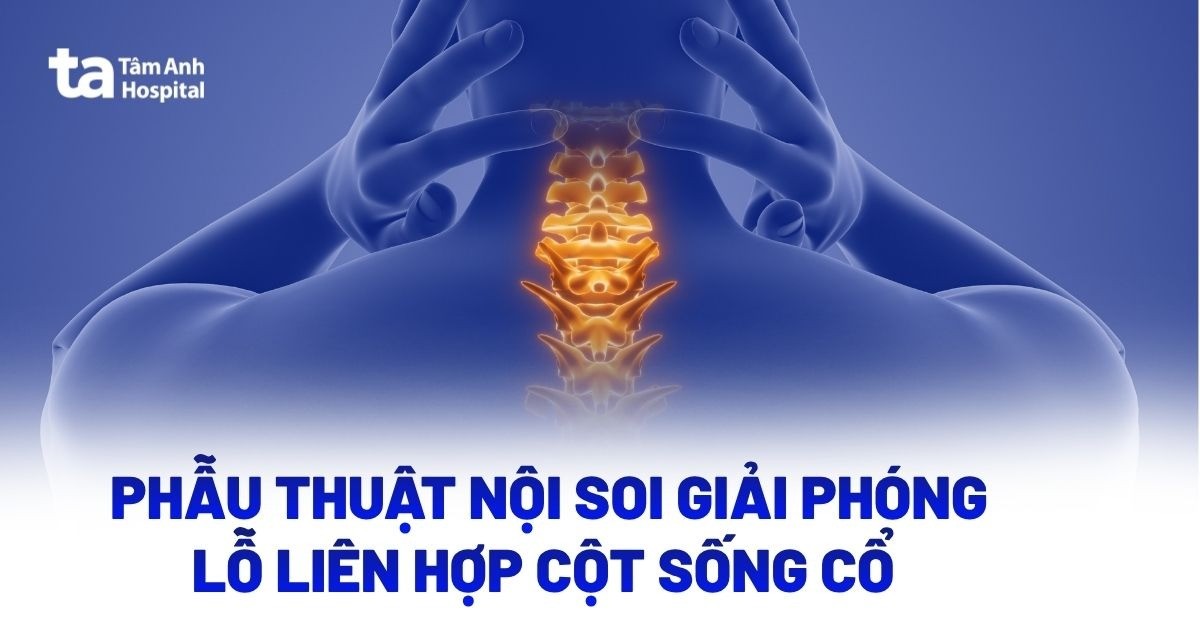 phẫu thuật nội soi giải phóng lỗ liên hợp cột sống cổ