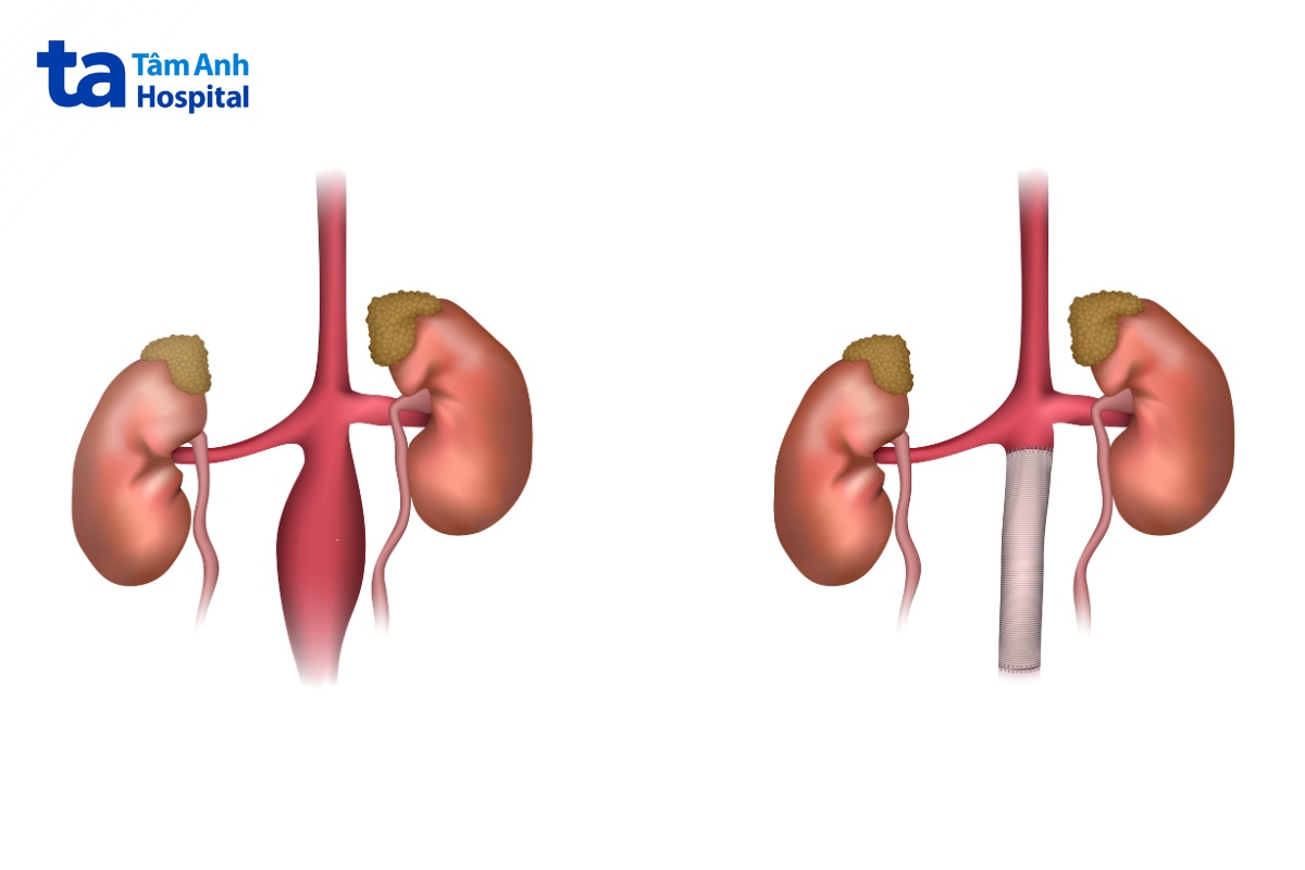 phẫu thuật phình động mạch chủ bụng