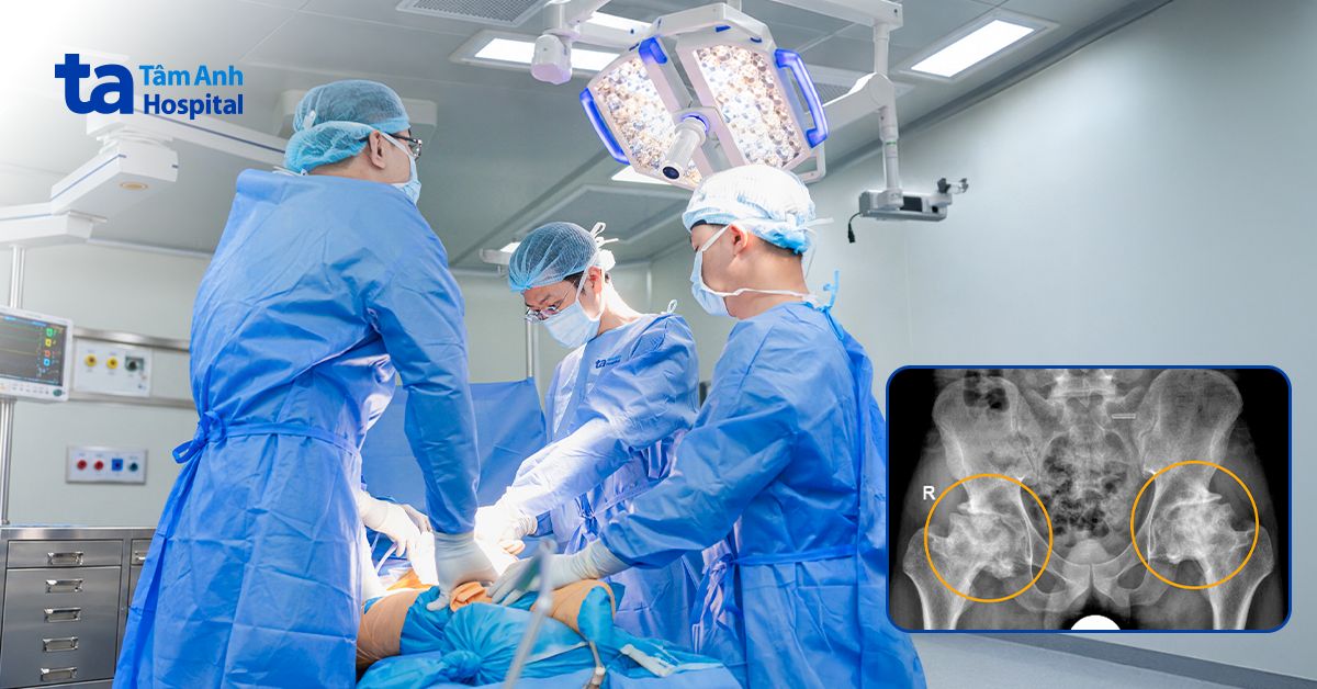 Phục hồi hai khớp háng hoại tử cho tài xế xe tải
