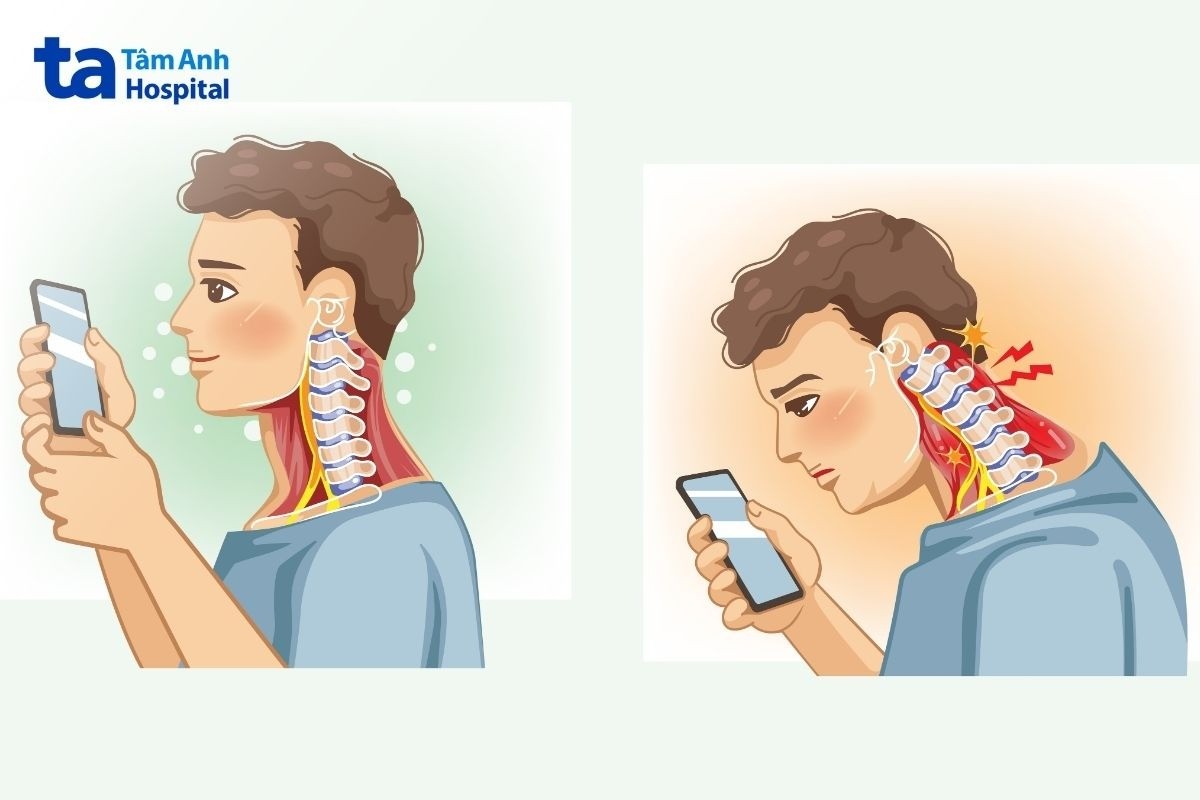 sai tư thế gây chấn thương cột sống cổ​