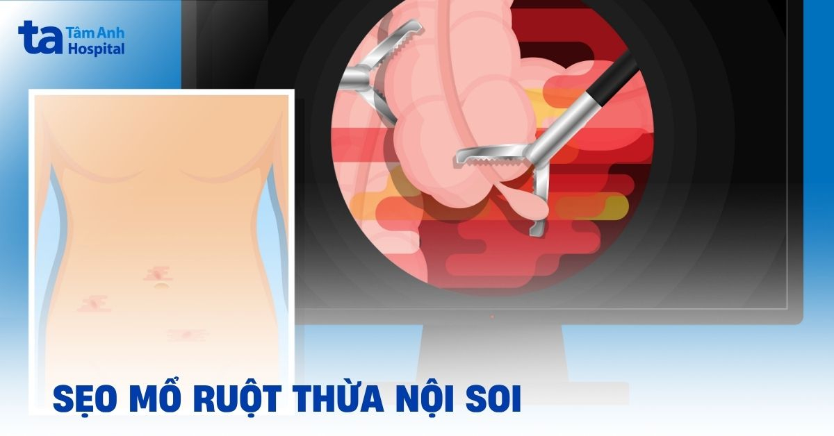 Sẹo Mổ Ruột Thừa Nội Soi