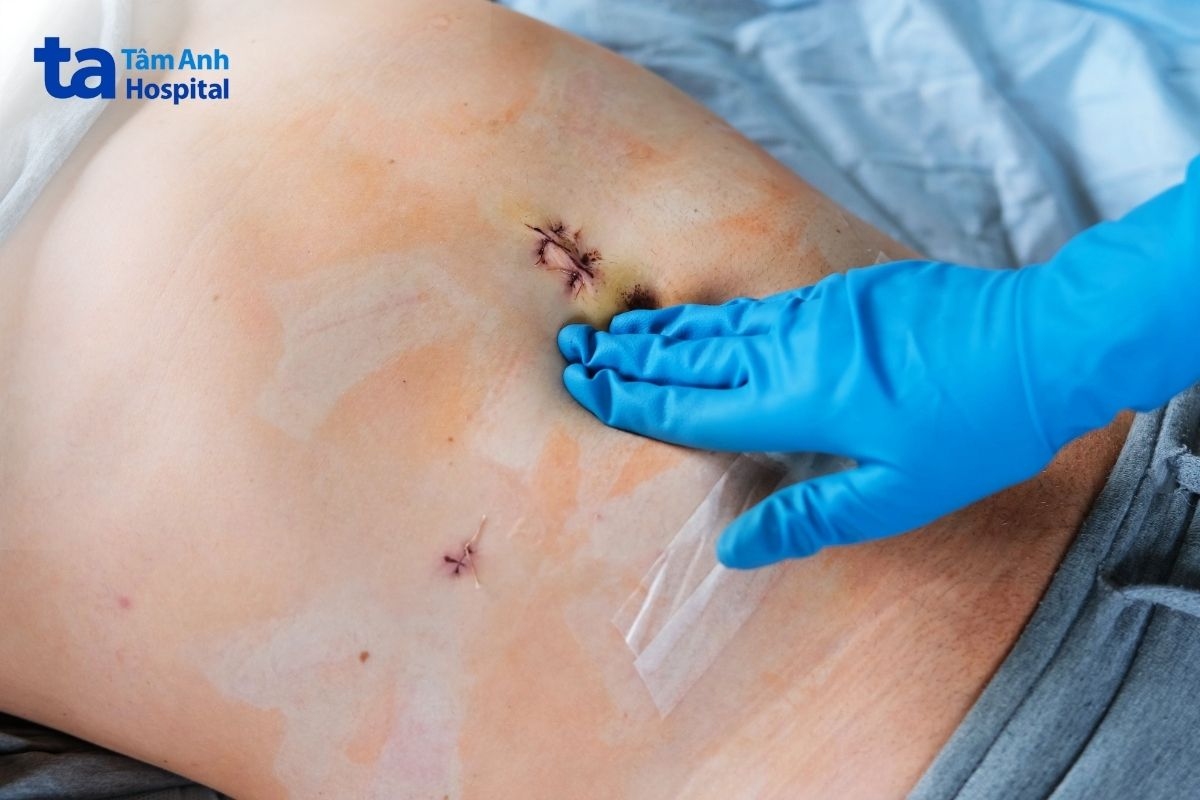 Sẹo Mổ Ruột Thừa