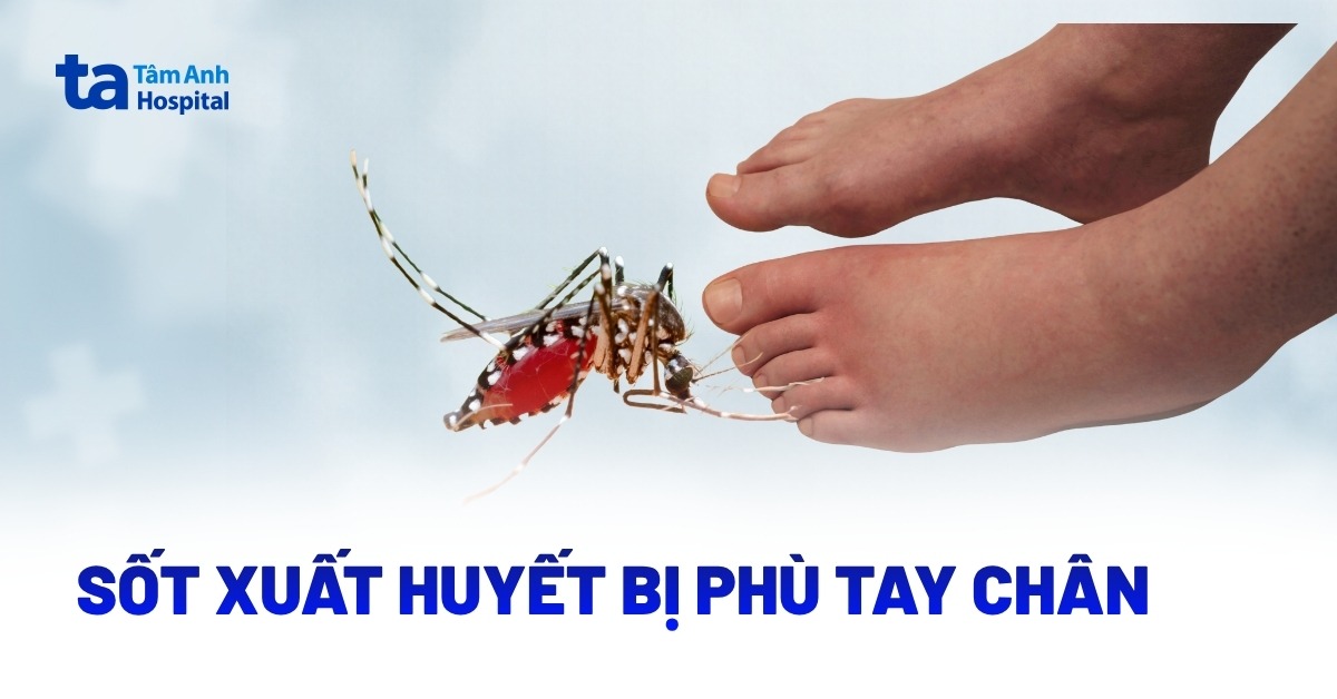 Người bệnh sốt xuất huyết bị phù tay chân có sao không?