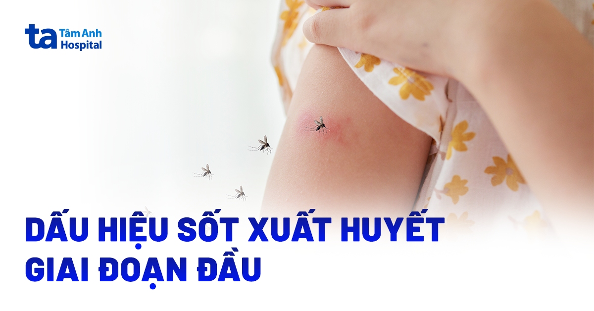 Sốt xuất huyết giai đoạn đầu (giai đoạn 1): Nhận biết thế nào?