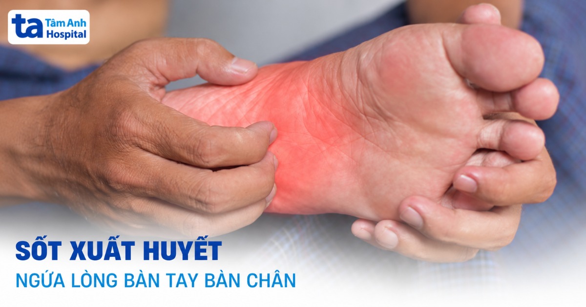 Sốt Xuất Huyết Ngứa Lòng Bàn Tay Bàn Chân