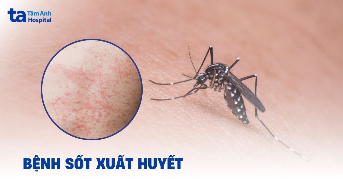 Sốt xuất huyết: Dấu hiệu, nguyên nhân, chẩn đoán, điều trị