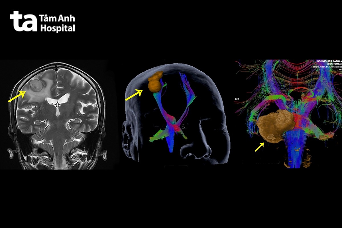 sự khác biệt giữa chụp khối u não bằng protocol mri thông thường và mri 3.0 tesla