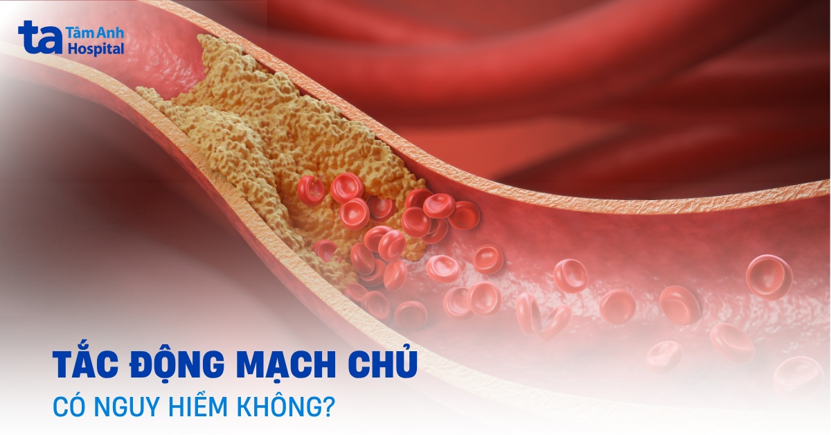 Tắc động mạch chủ là gì? Vì sao cần thận trọng?