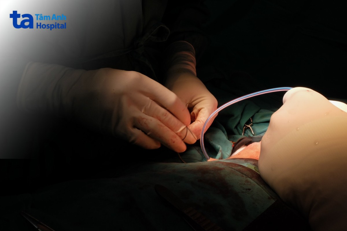 Tái Tạo Vú Tức Thì Bằng Vạt Cơ Lưng Rộng Được Thực Hiện Ngay Trong Cùng Một Ca Phẫu Thuật