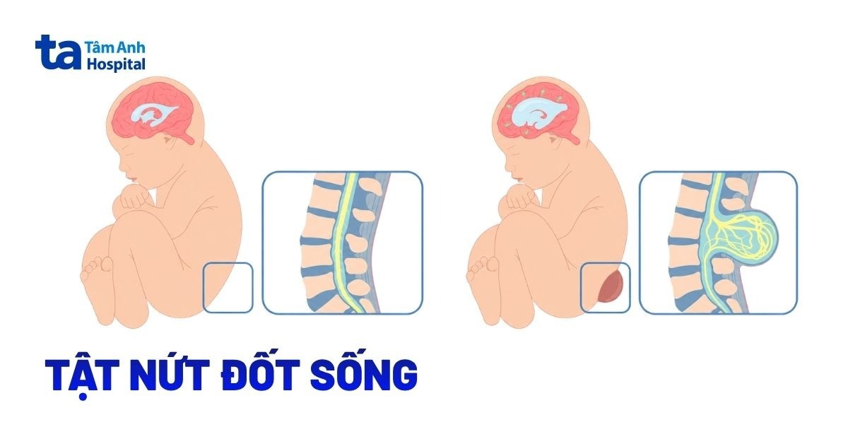 Tật nứt đốt sống là gì? Đâu là giải pháp khắc phục?