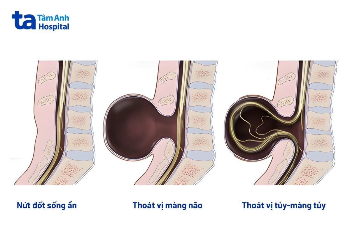 tật nứt đốt sốnglà dị tật bẩm sinh