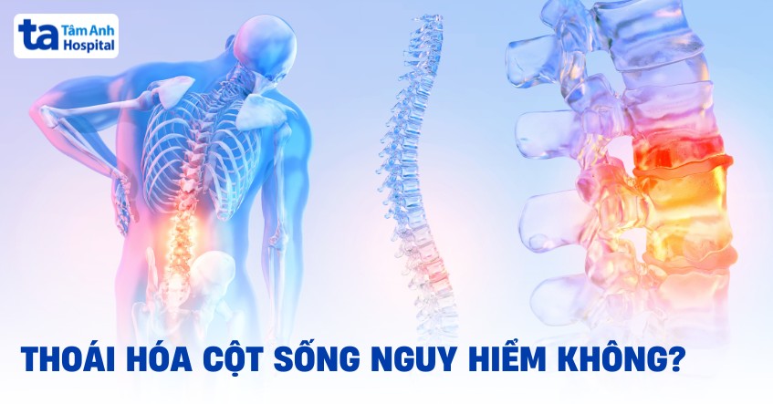 Thoái Hóa Cột Sống Có Nguy Hiểm Không
