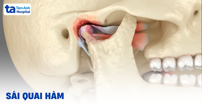 Sái quai hàm có tự khỏi được không? Dấu hiệu và cách chữa trị