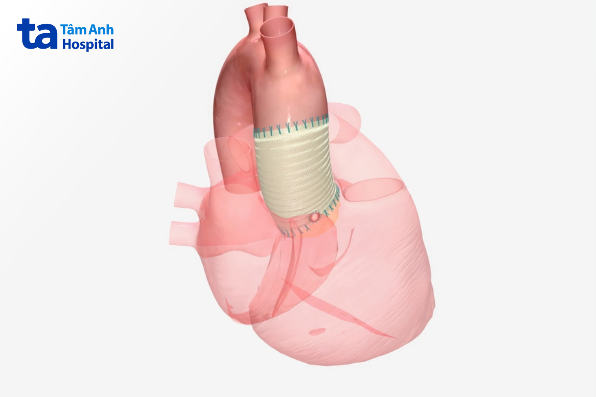 tình trạng động mạch phổi (mạch máu đưa máu từ tim lên phổi) bị to hoặc giãn