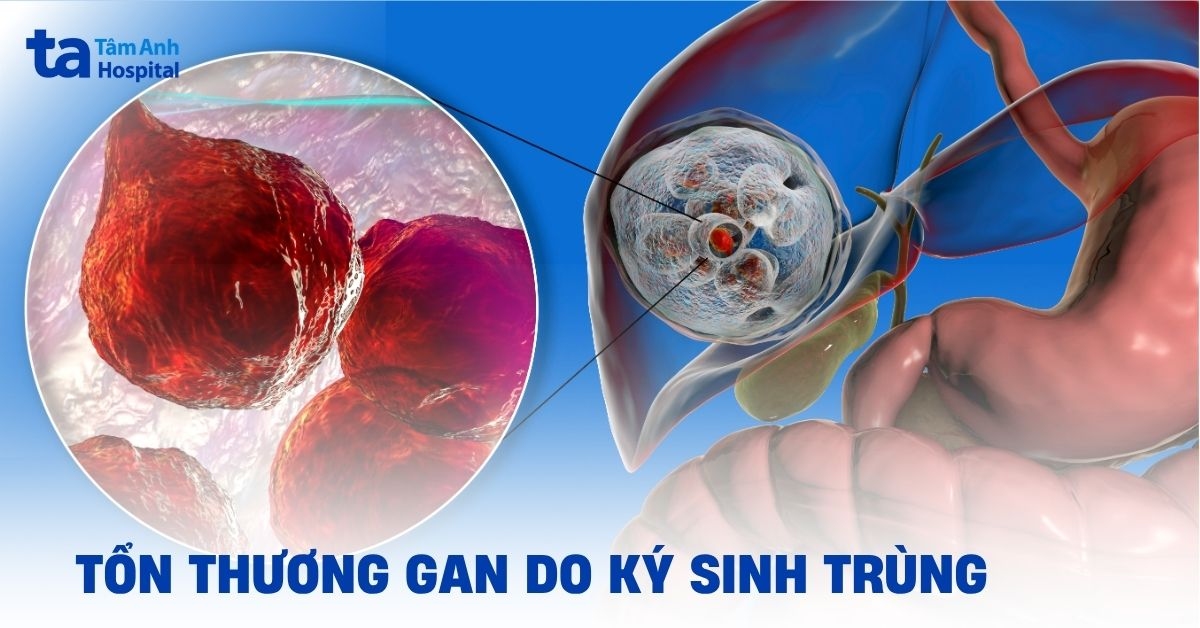 Tổn thương gan do ký sinh trùng: Dấu hiệu và cách xử trí