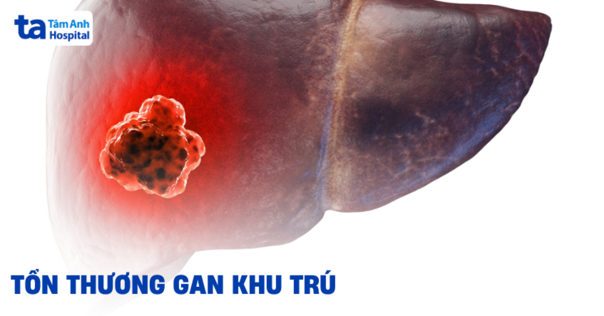 Tổn Thương Gan Khu Trú