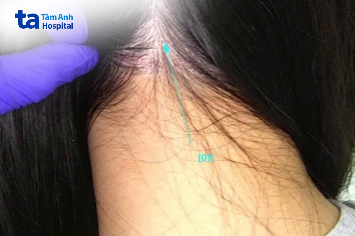 tổn thương viêm da tiết bã xuất hiện ở da đầu