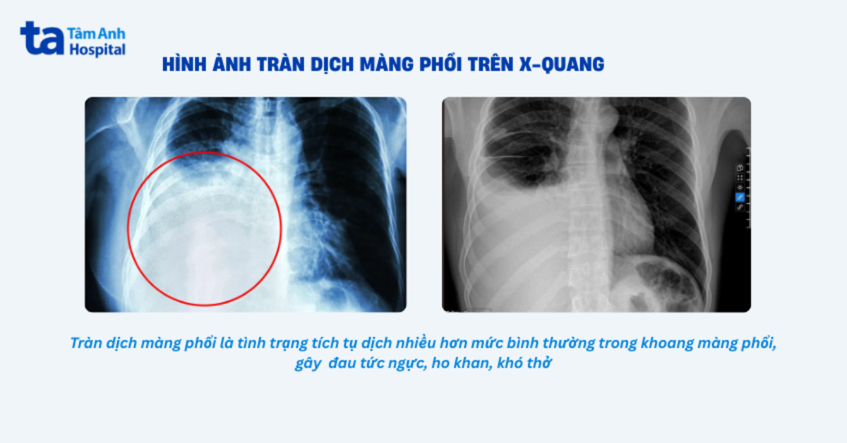 Tràn Dịch Màng Phổi Làm Hạn Chế Không Gian Giãn Nở Của Nhu Mô Phổi (1)