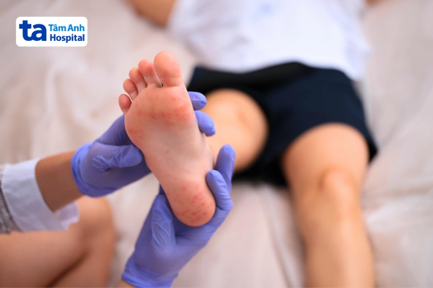 trẻ bị tay chân miệng ở chân