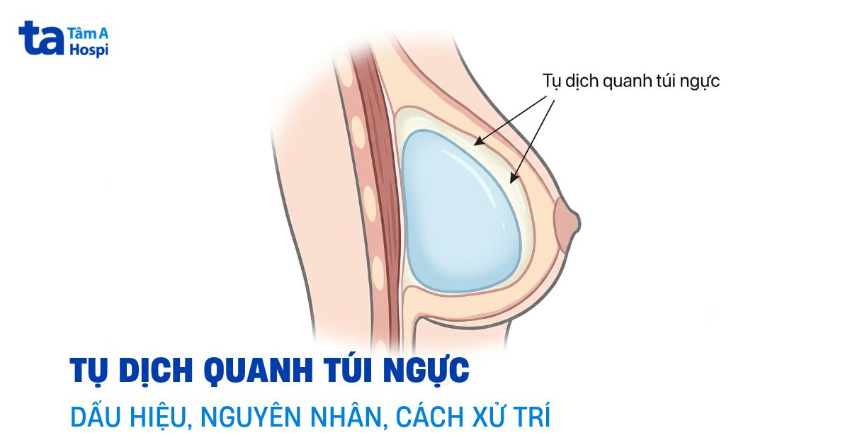 Tụ dịch quanh túi ngực (Peri-implant seroma)