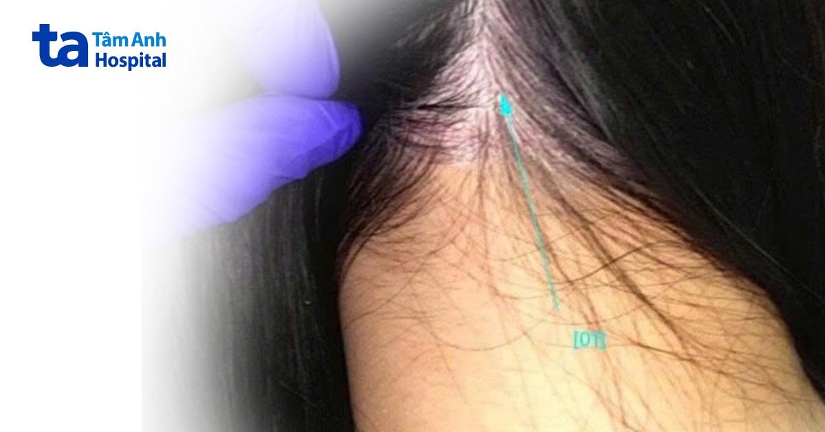 Tưởng đầu bị gàu hóa viêm da mạn tính