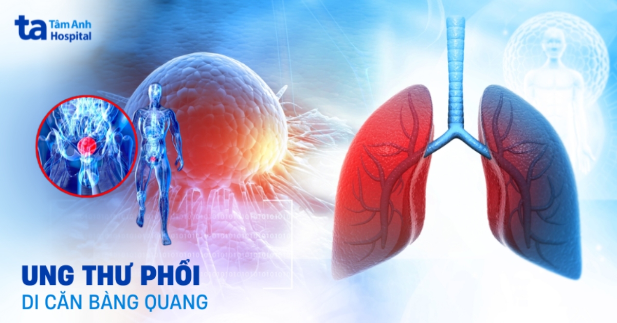Nhận biết ung thư phổi di căn bàng quang qua biểu hiện nào?