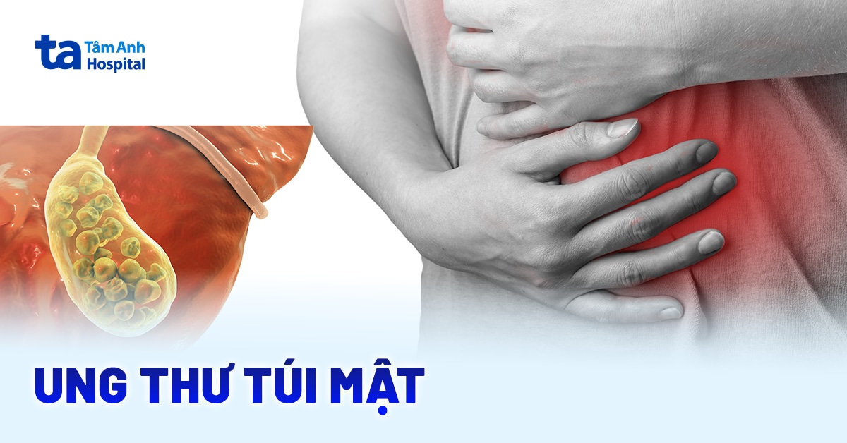 Ung thư túi mật: Nguyên nhân, triệu chứng và chẩn đoán