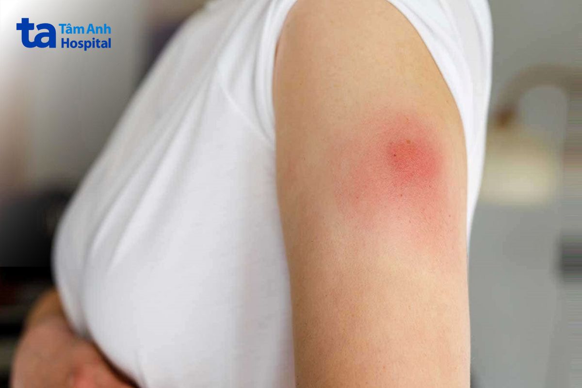 vết sưng đỏ tại vị trí tiêm vắc xin