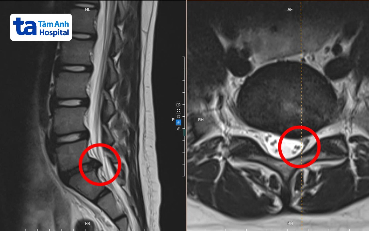 Vị trí khối thoát vị chèn ép thần kinh của Nam trên phim chụp MRI. Vị trí khối thoát vị chèn ép thần kinh của Nam trên phim chụp MRI.