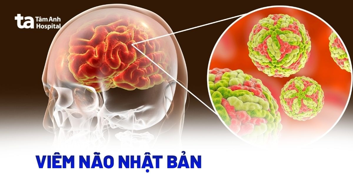 Viêm não Nhật Bản: Nguyên nhân và đặc điểm nhận biết