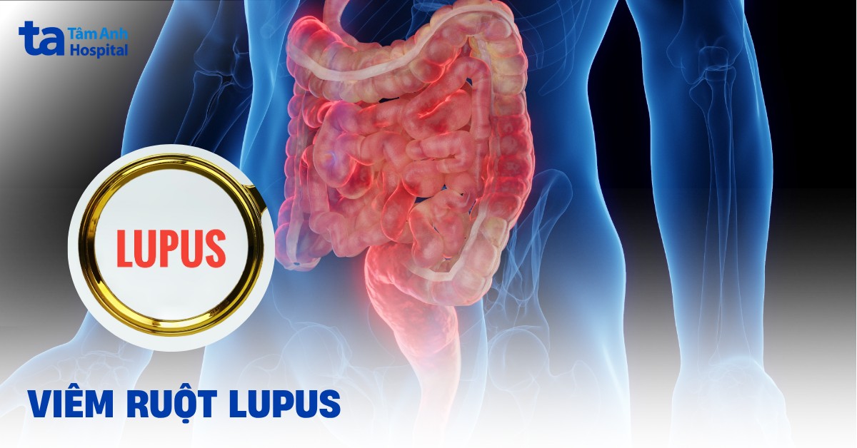 Viêm ruột lupus có nguyên nhân do đâu?