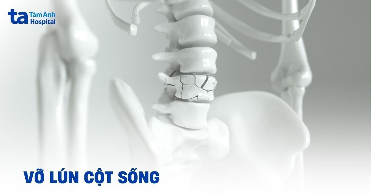 Vỡ lún cột sống: Hiểu đúng để xử trí