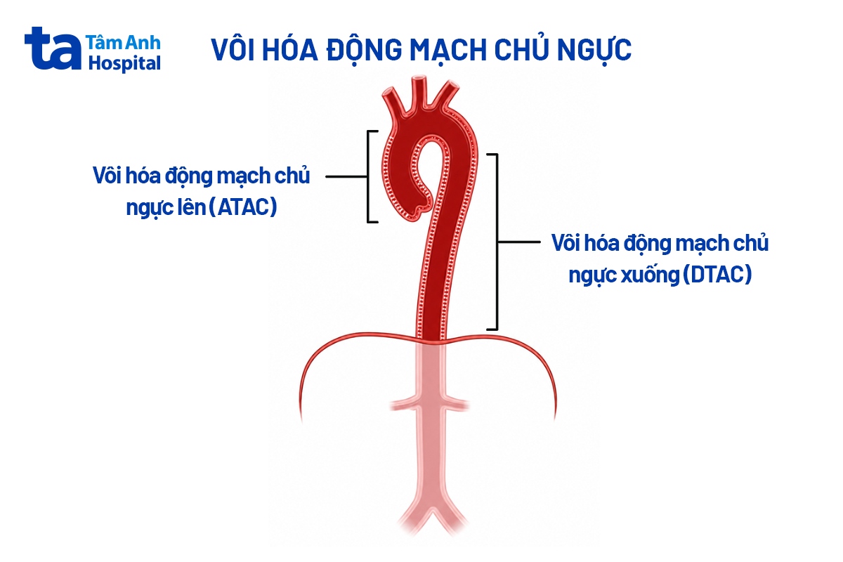 Vôi Hóa Thành Quai Cung Động Mạch Chủ Là Gì