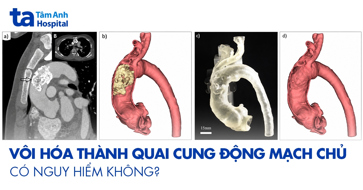 Vôi Hóa Thành Quai Cung Động Mạch Chủ