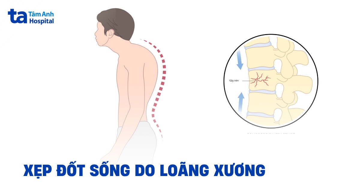 Xẹp đốt sống do loãng xương cần giải pháp nào để khắc phục?