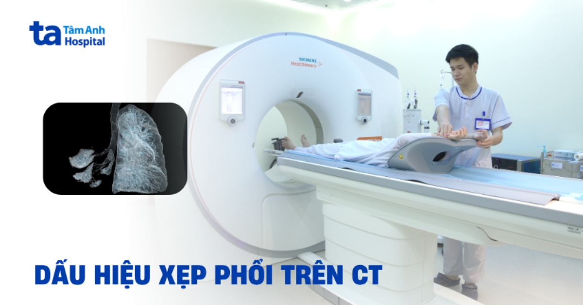 Dấu hiệu xẹp phổi trên CT không nên bỏ sót